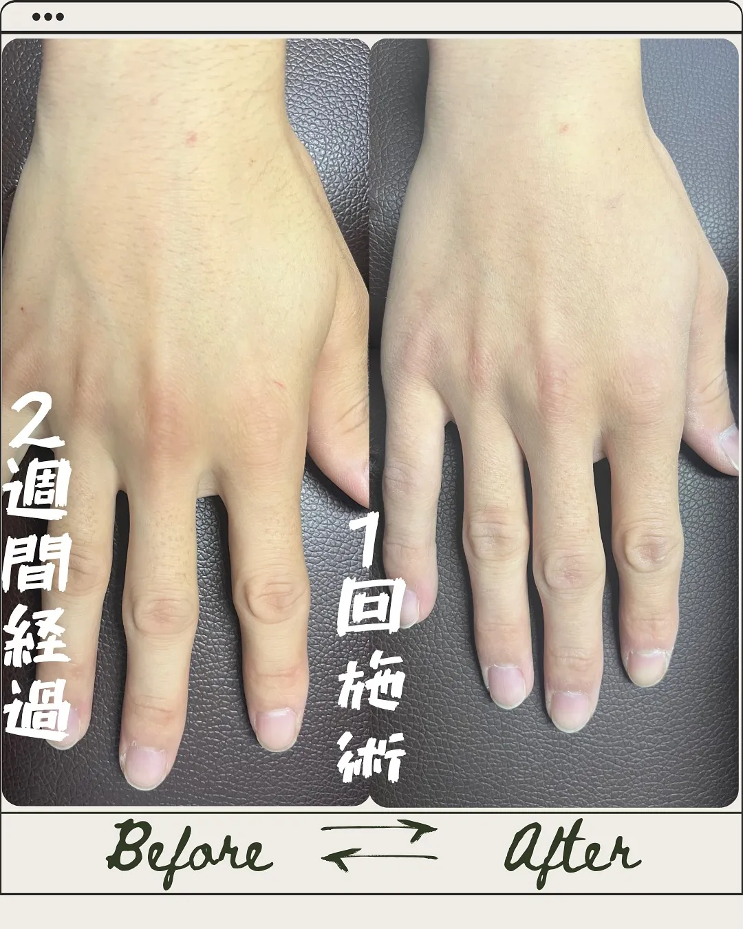 🖐️「たった1回の脱毛です✨」
