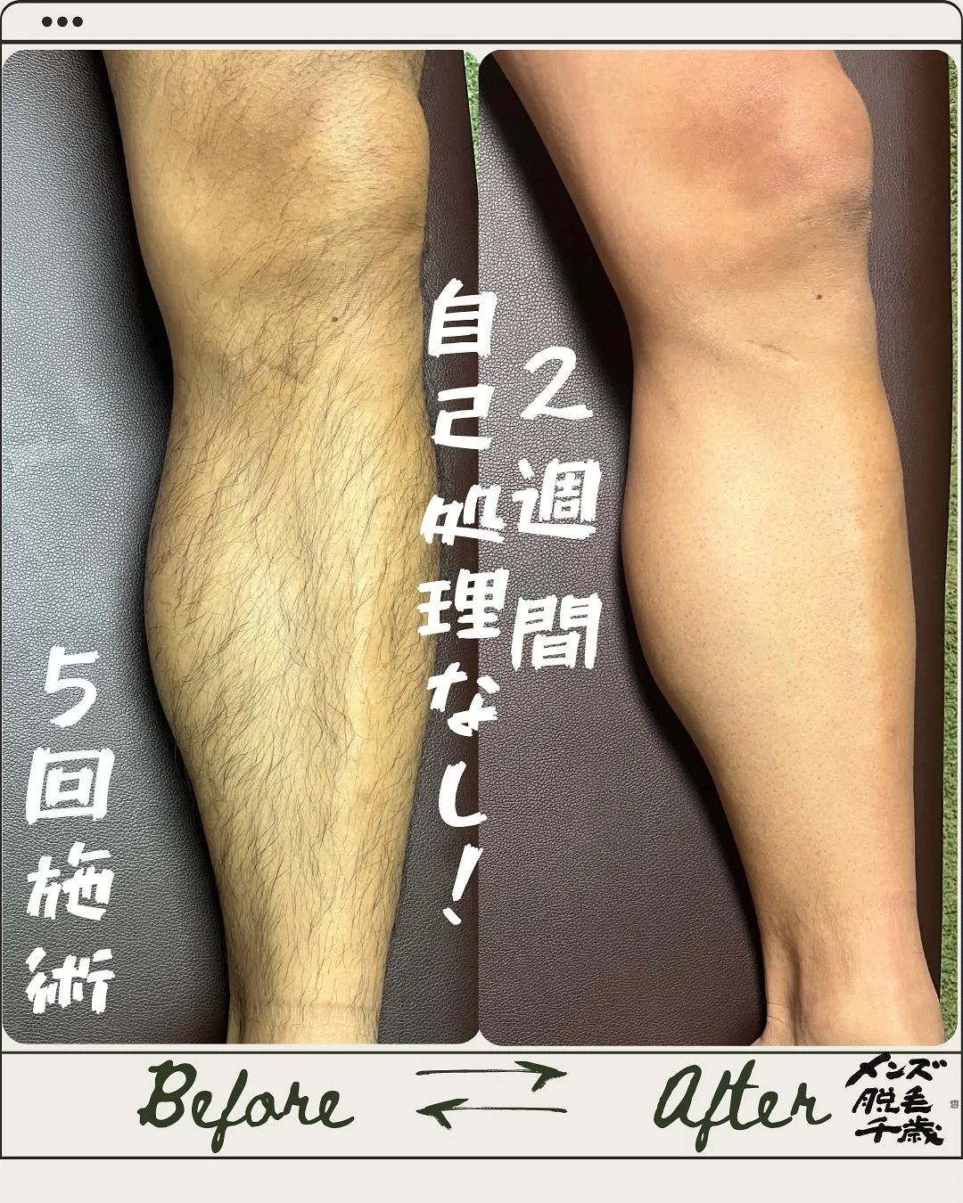 ＼ひざ下の脱毛、こんなに変わる！／