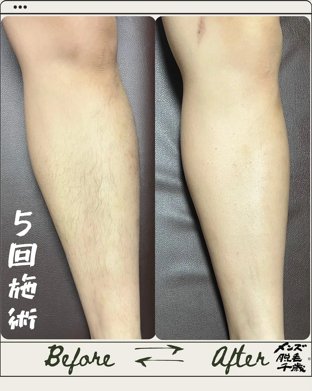 5回の施術でこの変化✨