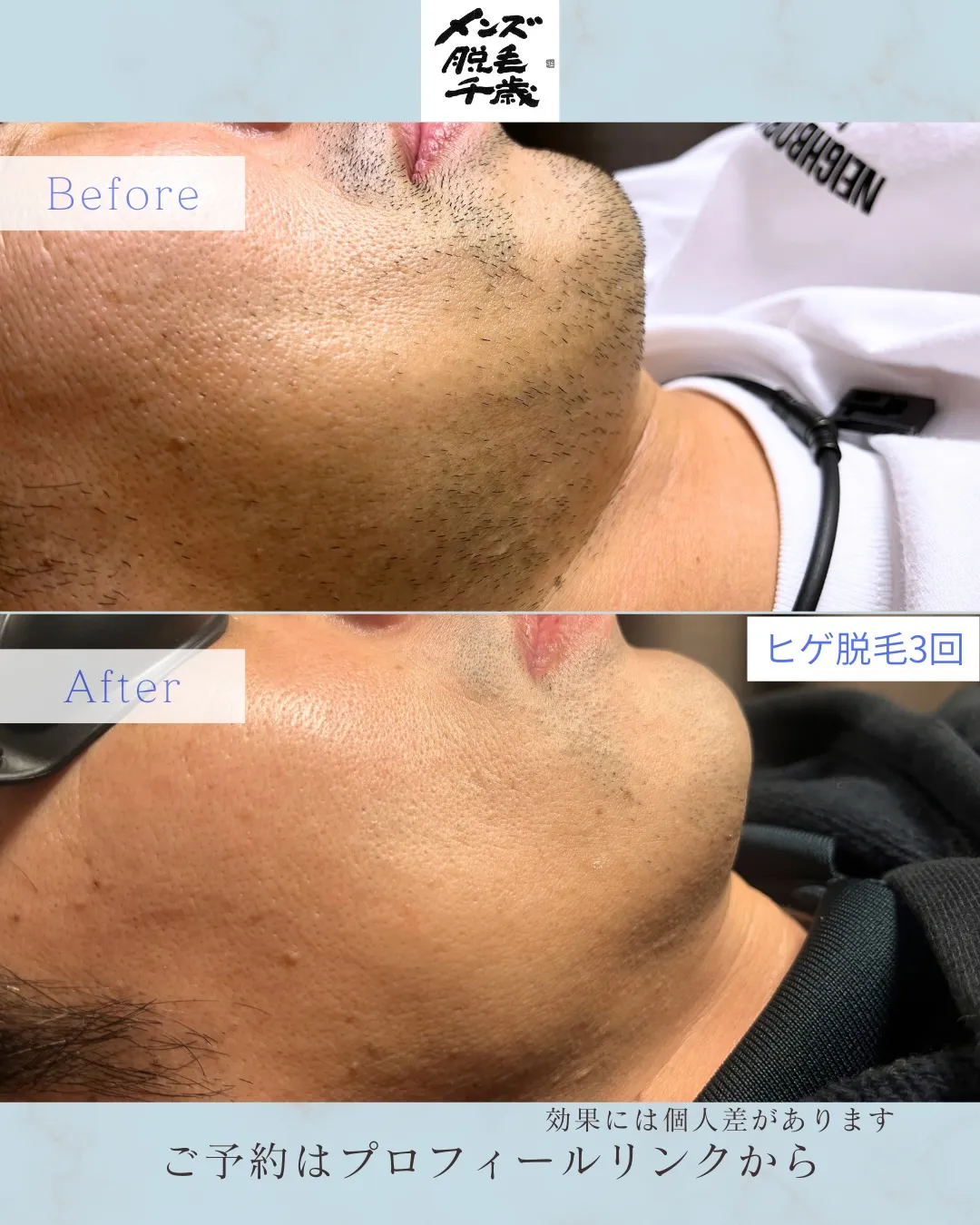 📸【ヒゲ脱毛 Before→After（3回）】