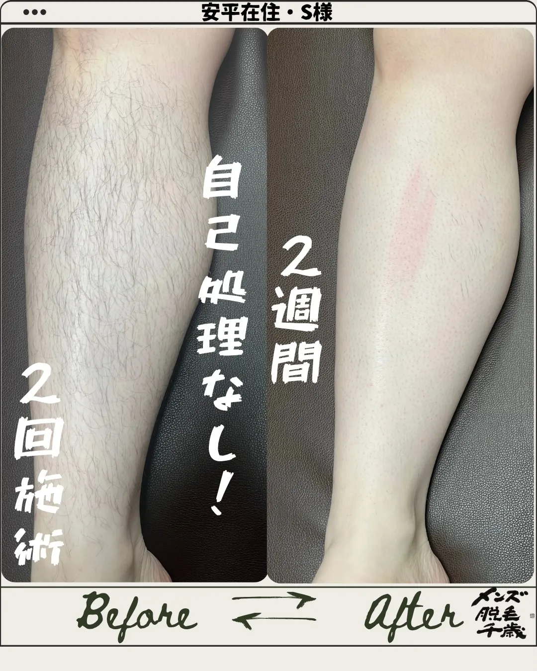 【たった2回でこの違い💥 夏、まだ間に合います！】