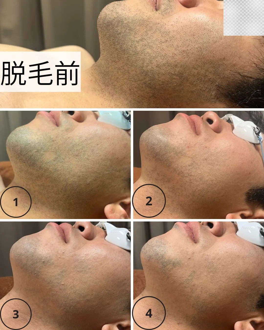 【たった4回でこの変化✨】